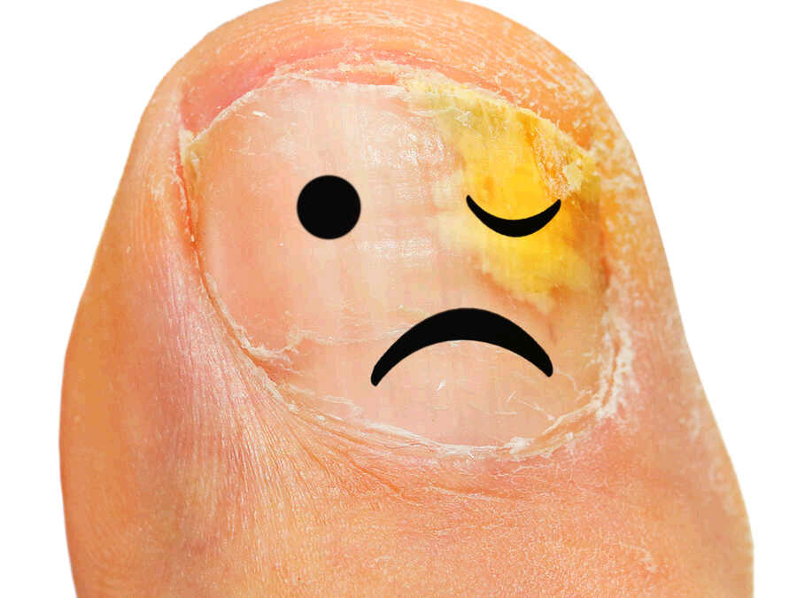 Can You Use Bleach For Toe Fungus