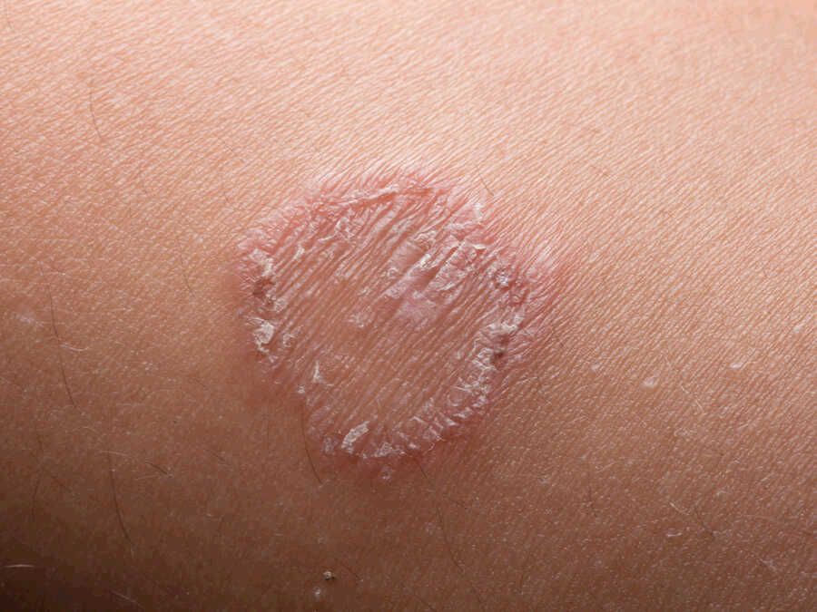 3-symptoms-that-may-indicate-a-ringworm-treating-fungus