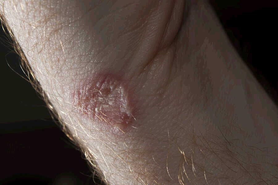 ringworm-on-the-skin-of-a-person-the-alternative-daily